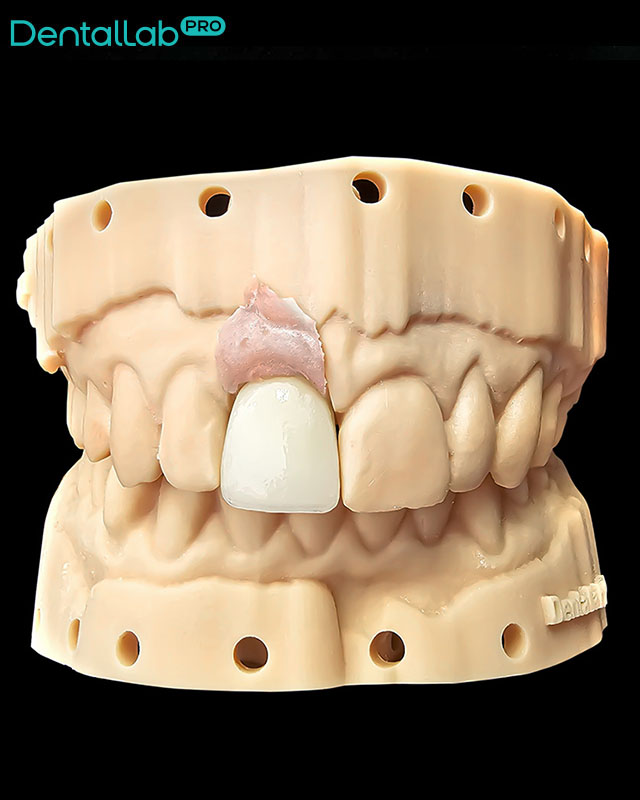 Korona, cyrkon, ceramika.