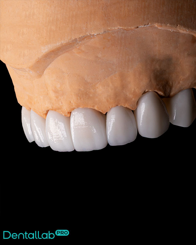 Korony pełnoceramiczne i most na implantach.