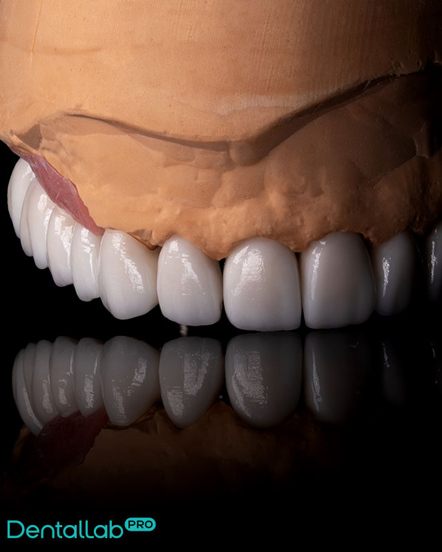 Korony pełnoceramiczne i most na implantach.