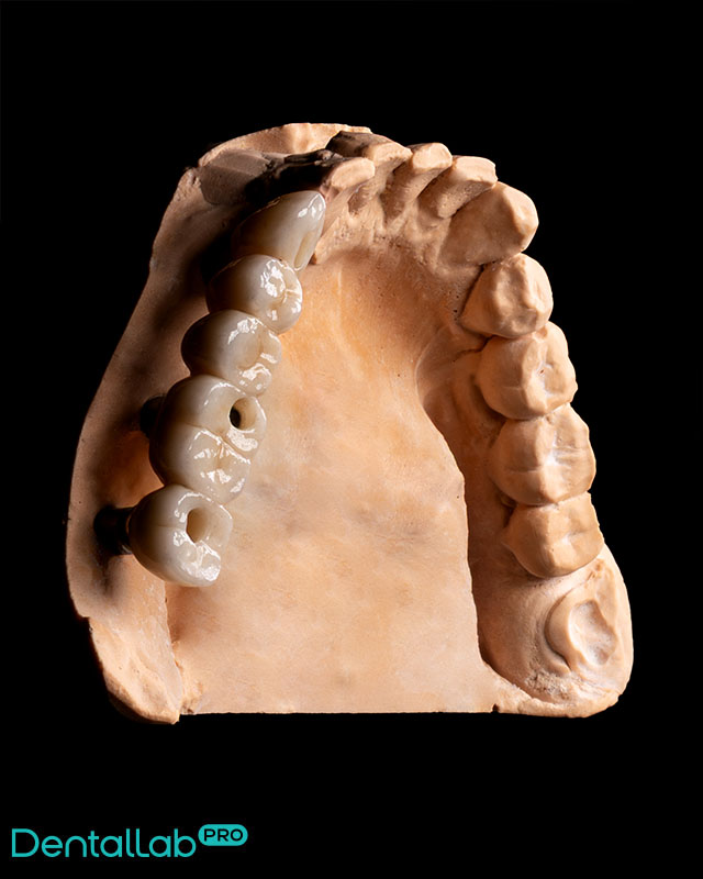  Most pełnoceramiczny na implantach.