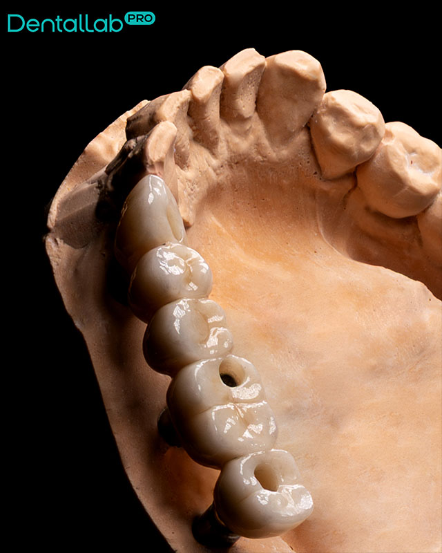  Most pełnoceramiczny na implantach.