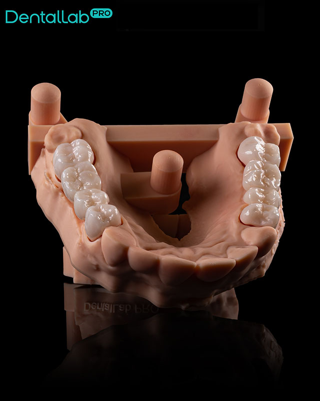 Mosty pełnoceramiczne, skan wewnątrzustny.