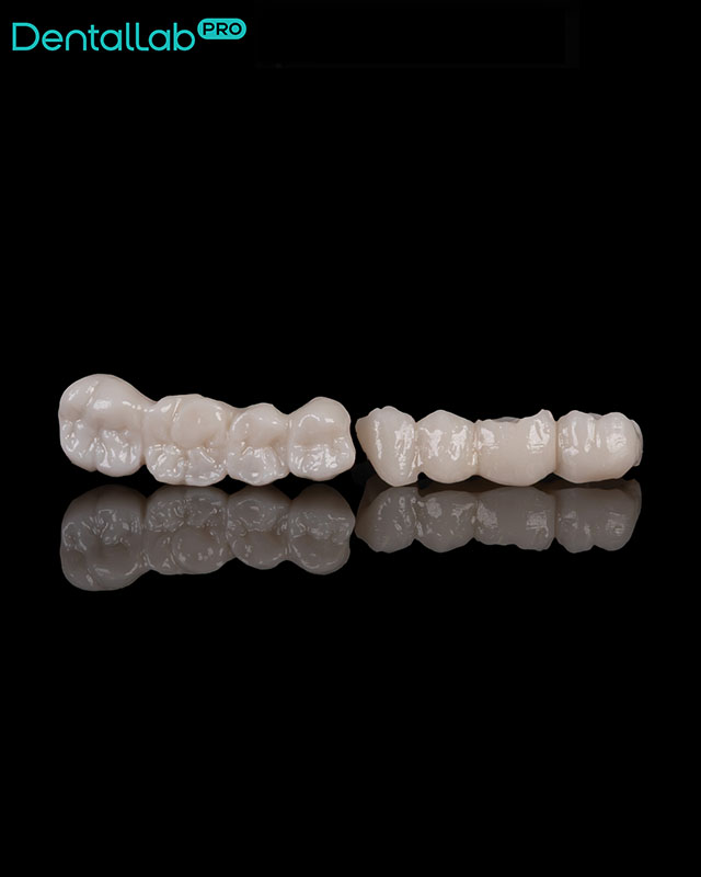 Mosty pełnoceramiczne, skan wewnątrzustny.