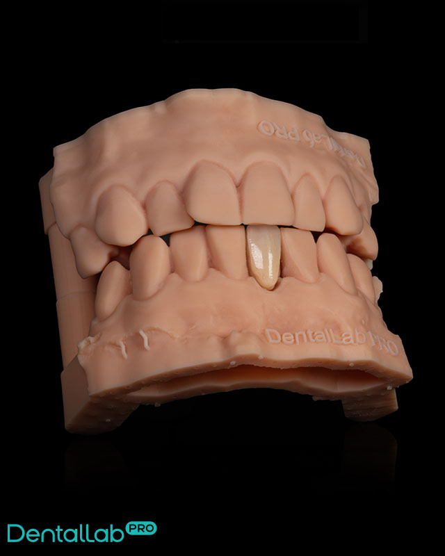 Most athezyjny merland pełnoceramiczny.