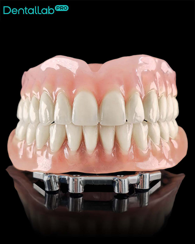 Proteza górna całkowita. Proteza dolna osadzona na belce doldera.