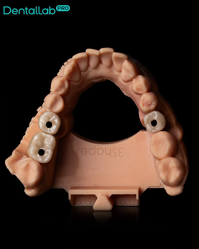 Korony pełnoceramiczne na łącznikach indywidualnych.