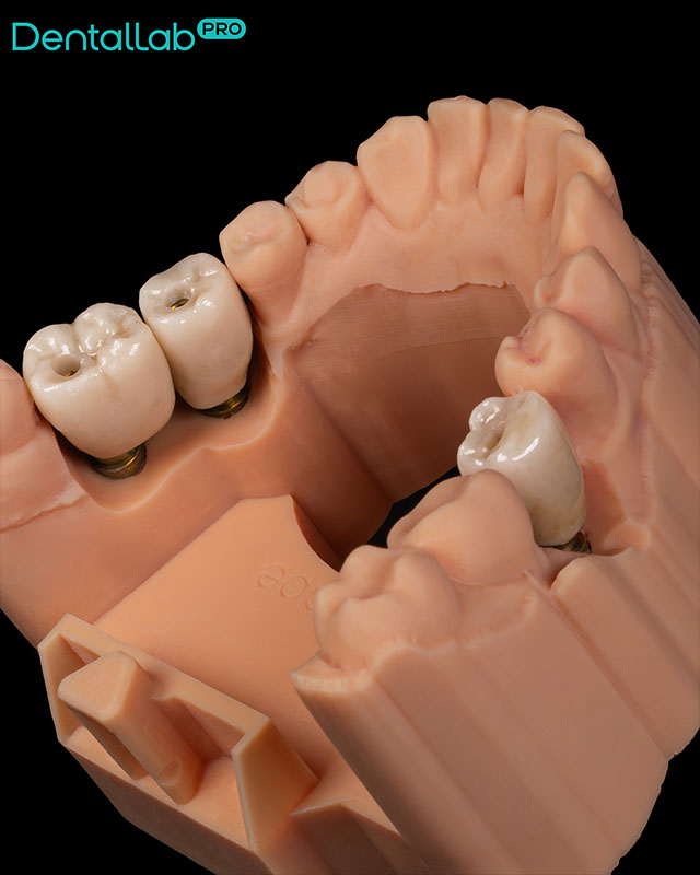 Korony pełnoceramiczne na łącznikach indywidualnych.