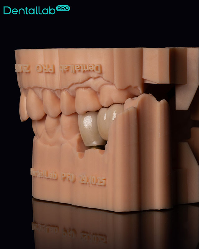 Korony pełnoceramiczne na łącznikach indywidualnych.