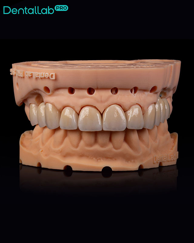  Korony pełnoceramiczne, na modelu z wyciąganymi pinami.