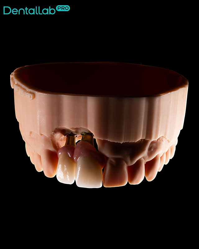  Korony pełnoceramiczne na implantach z odbudowanym dziąsłem.