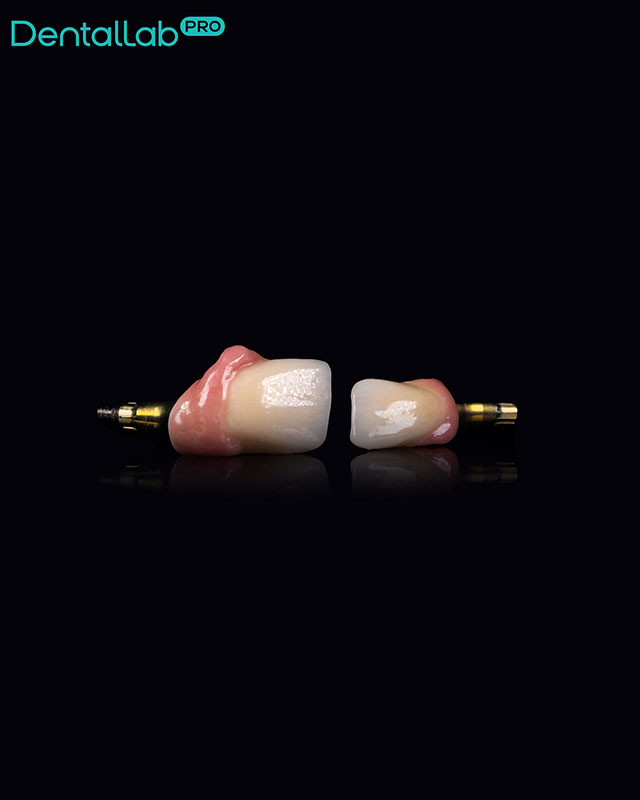  Korony pełnoceramiczne na implantach z odbudowanym dziąsłem.