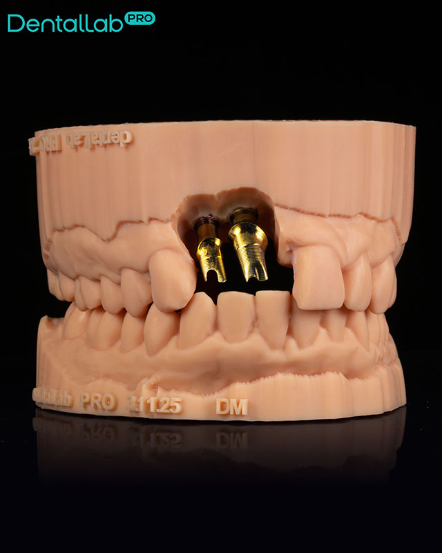  Korony pełnoceramiczne na implantach z odbudowanym dziąsłem.