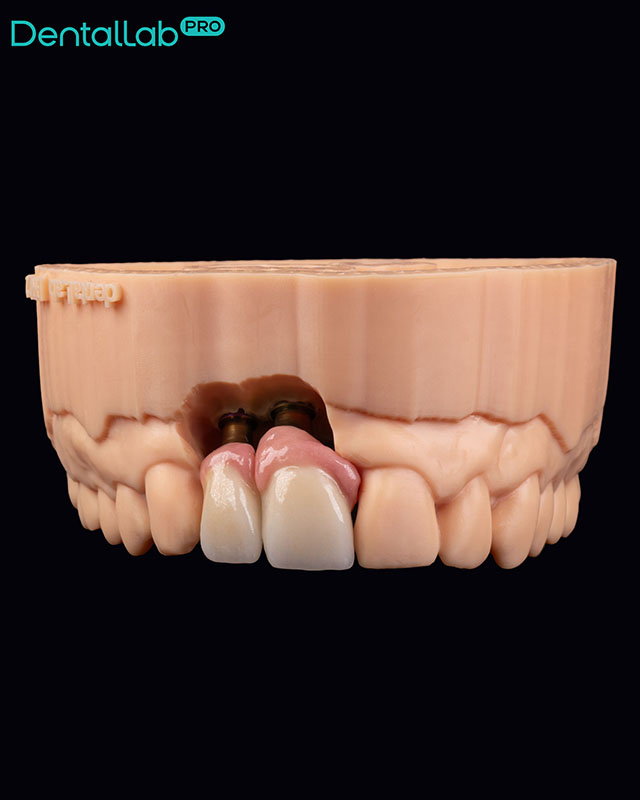  Korony pełnoceramiczne na implantach z odbudowanym dziąsłem.