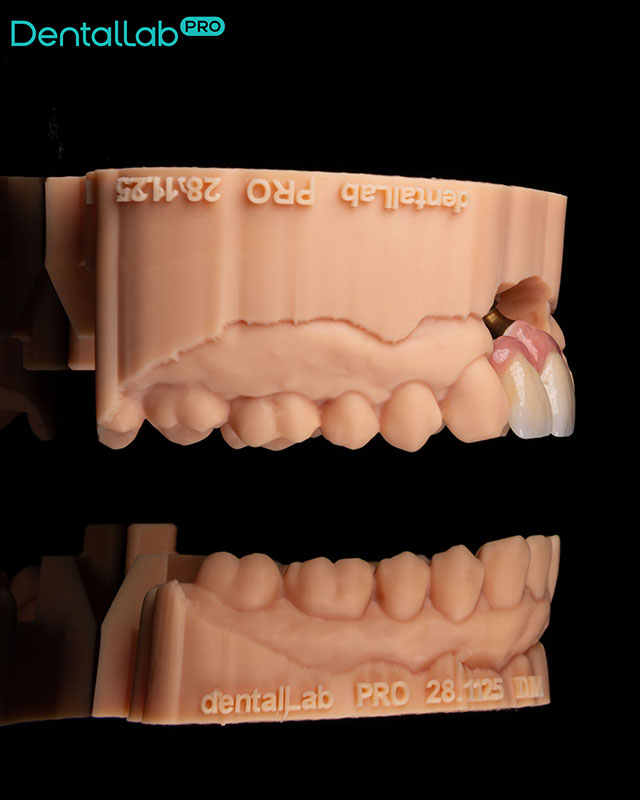  Korony pełnoceramiczne na implantach z odbudowanym dziąsłem.