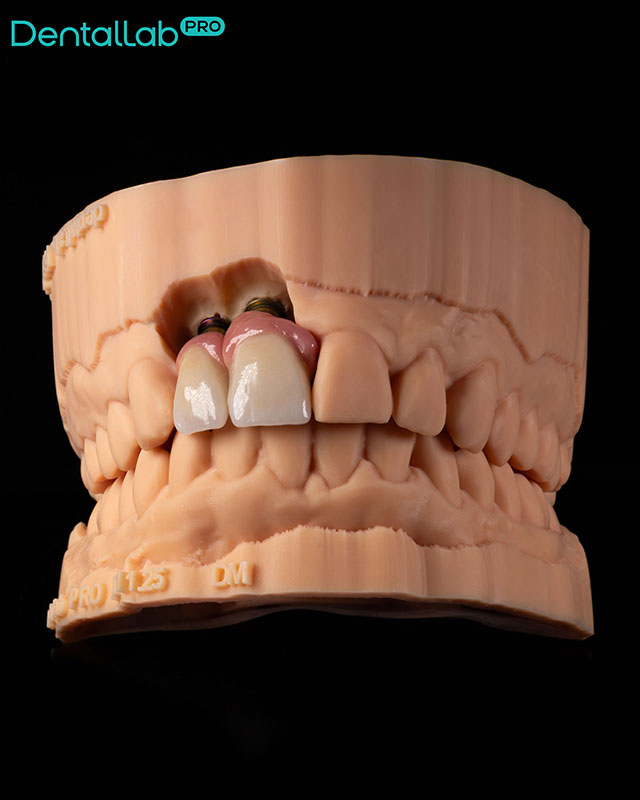  Korony pełnoceramiczne na implantach z odbudowanym dziąsłem.