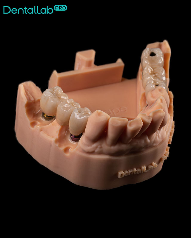  Korony pełnoceramiczne na implantach.