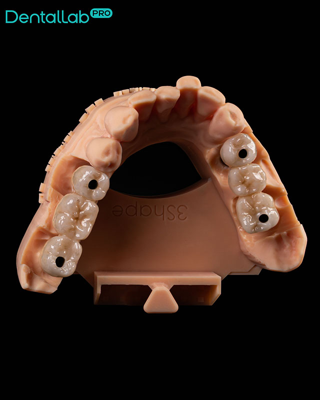  Korony pełnoceramiczne na implantach.