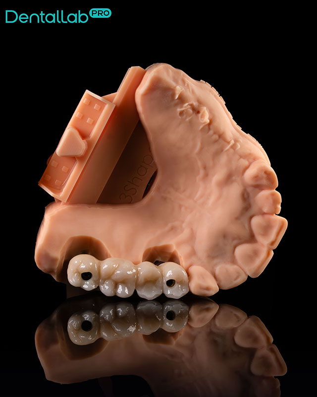  Korony pełnoceramiczne na implantach.