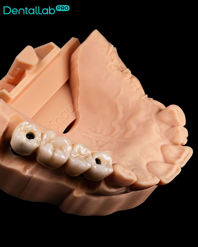  Korony pełnoceramiczne na implantach.