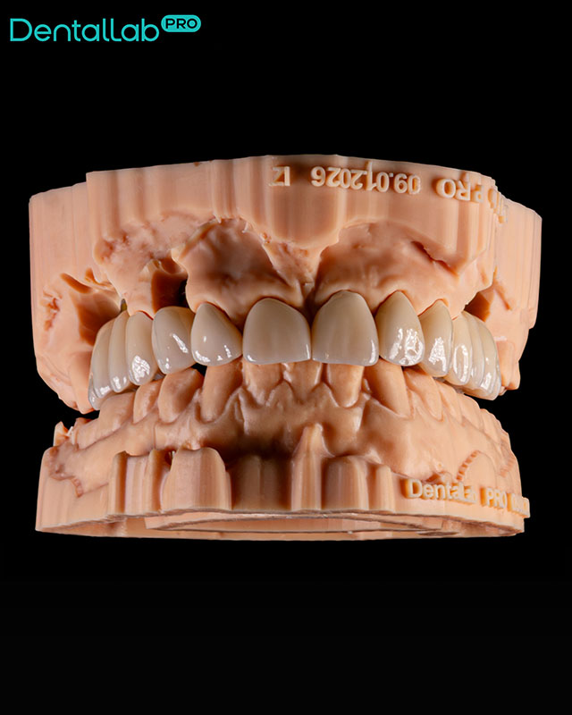  Korony pełnokonturowe.
