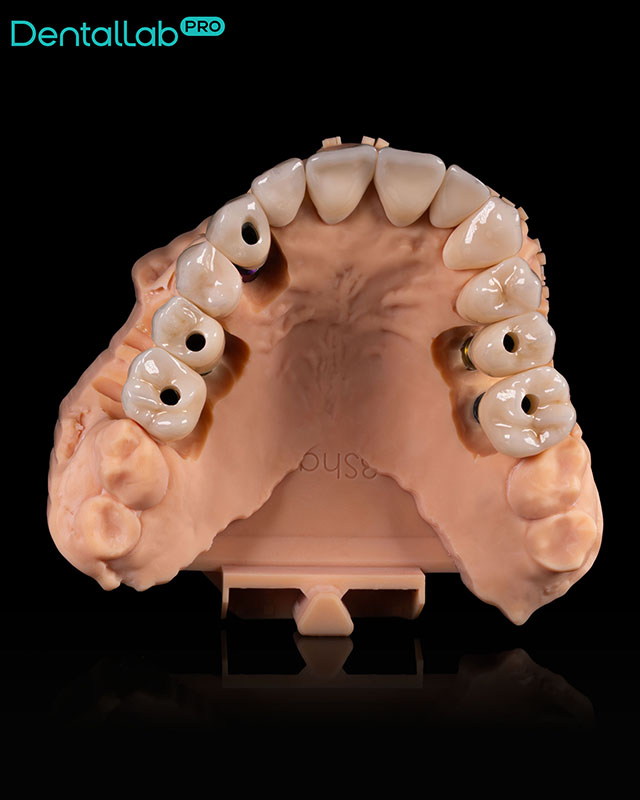  Korony pełnokonturowe.
