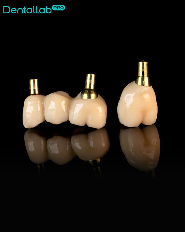  Korony ceramiczne na systemie Bicon.
