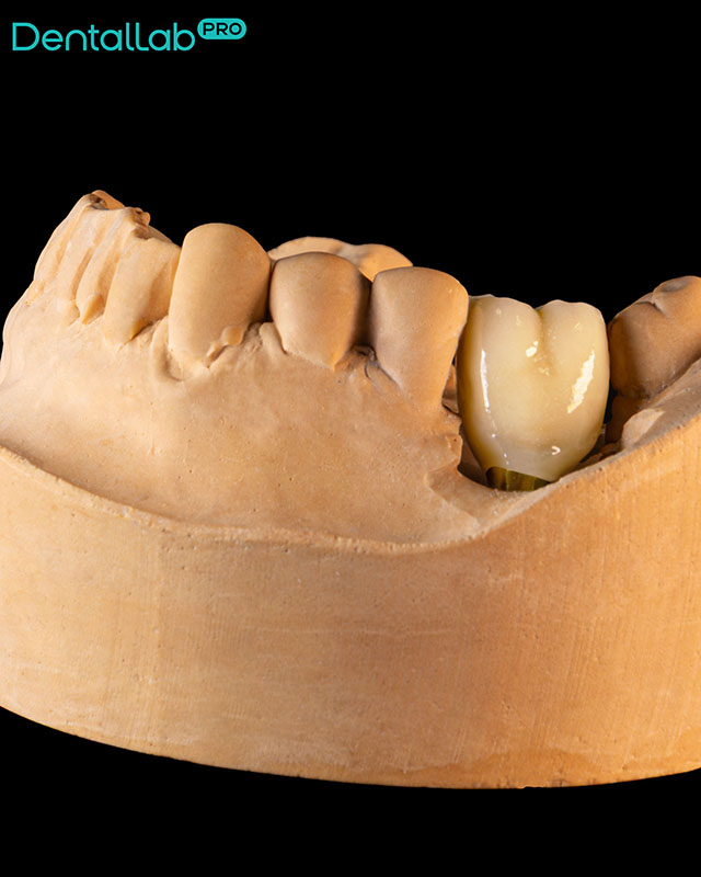  Korony ceramiczne na systemie Bicon.
