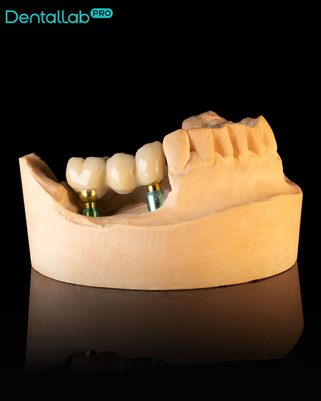  Korony ceramiczne na systemie Bicon.
