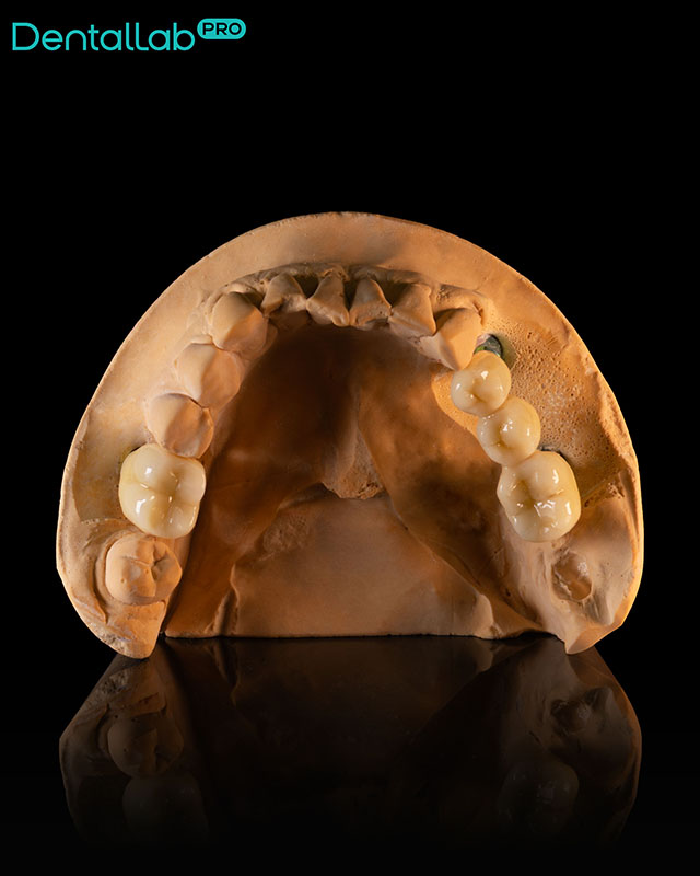  Korony ceramiczne na systemie Bicon.
