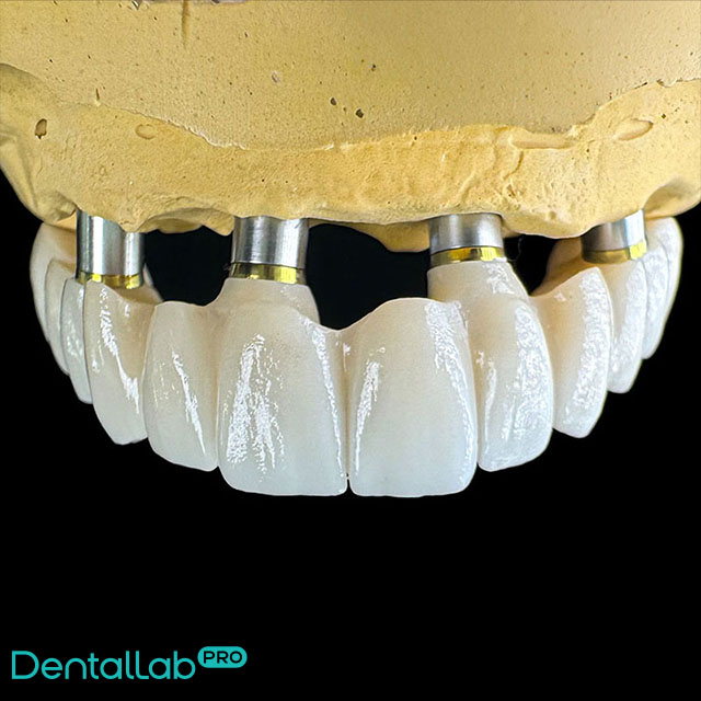 Most ceramiczny na implantach.