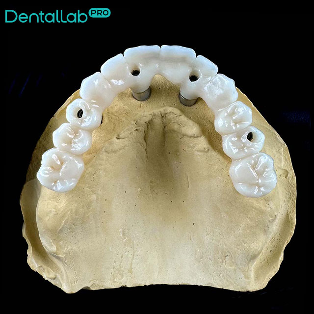 Most ceramiczny na implantach.