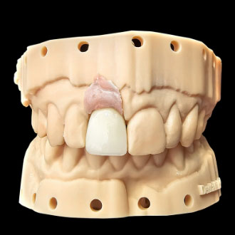 Korona, cyrkon, ceramika.