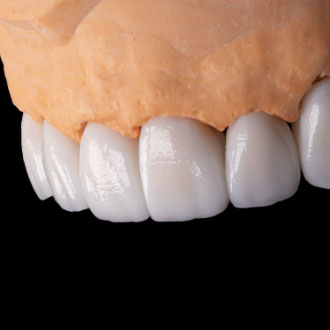 Korony pełnoceramiczne i most na implantach.