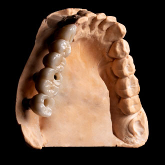  Most pełnoceramiczny na implantach.