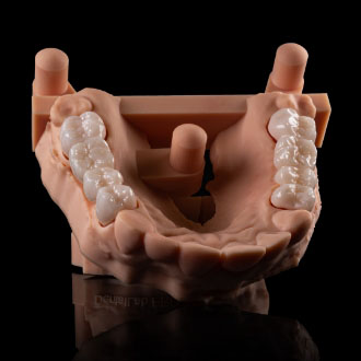 Mosty pełnoceramiczne, skan wewnątrzustny.