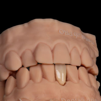 Most athezyjny merland pełnoceramiczny.