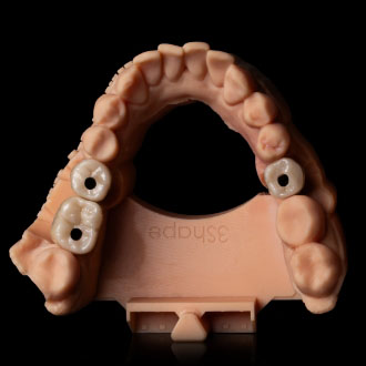 Korony pełnoceramiczne na łącznikach indywidualnych.