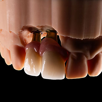  Korony pełnoceramiczne na implantach z odbudowanym dziąsłem.