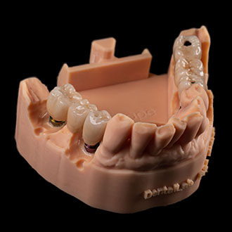  Korony pełnoceramiczne na implantach.