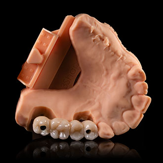  Korony pełnoceramiczne na implantach.