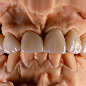  Korony pełnokonturowe.
