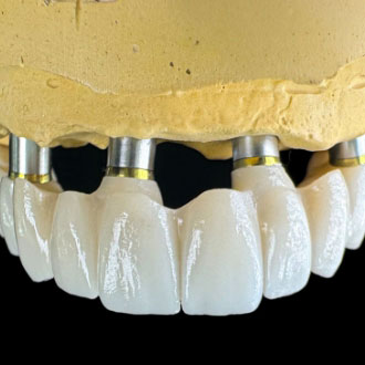 Most ceramiczny na implantach.