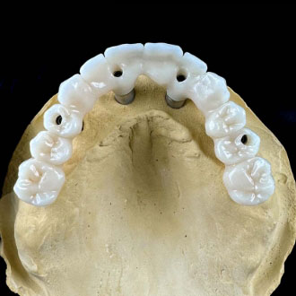 Most ceramiczny na implantach.